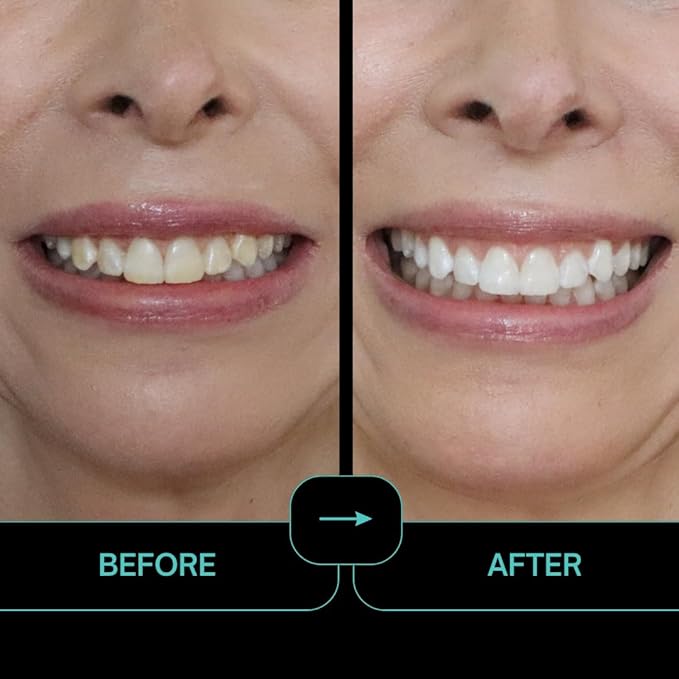 Prostrips - 12 Shades Whiter Teeth - 56 Enamel Safe REMINERALIZING Gentle Strips – 97% Had No Sensitivity - Bonus Size
