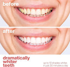 AquaSonic Professional Teeth Whitening Strips - Enamel Safe Teeth Whitening with Hydrogen Peroxide - Easy to Use, Non-Slip, Affordable & Effective (Watermelon)