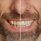 Bright White Smiles 44% Teeth Whitening Gel Syringe Refill Pack, Carbamide Peroxide, 5 Syringes (3ml),Tooth Whitener Formula