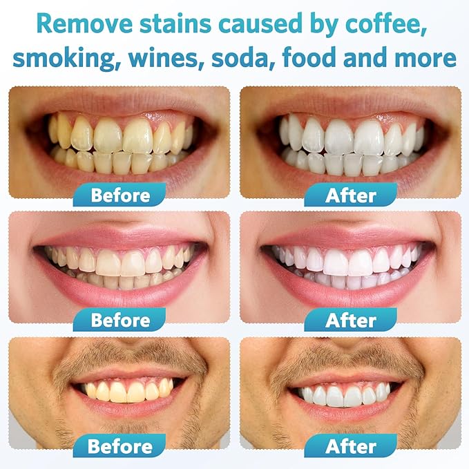 BESTEK Teeth Whitening Kit – 32X LED Light, 10-Min Fast Whitening, 4 Tubes of 35% Carbamide Peroxide Gel, Removes Coffee, Wine & Tobacco Stains - Red