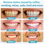 BESTEK Teeth Whitening Kit – 32X LED Light, 10-Min Fast Whitening, 4 Tubes of 35% Carbamide Peroxide Gel, Removes Coffee, Wine & Tobacco Stains - Yellow