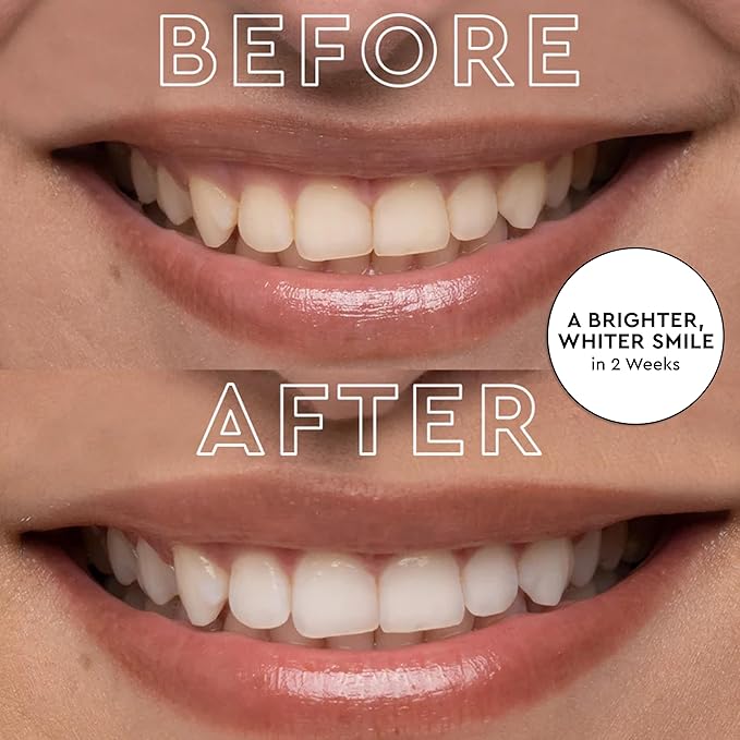 MOON LED Teeth Whitening Kit - Gentle Teeth Whitener Device, 56 White Strips, USB Charger & Travel Case - Blue Light Whitening Tray Removes Stains & Whitens Up to 12 Shades in 2 Weeks (4 Piece Kit)